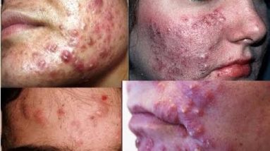 CBD (Cannabidiol), applied topically, fights acne problems…