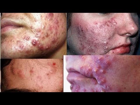 CBD (Cannabidiol), applied topically, fights acne problems…