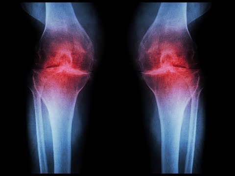 CBD AS A TREATMENT FOR ARTHRITIS