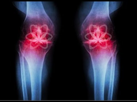 CBD: WHY ARTHRITIS PEOPLE USE CBD