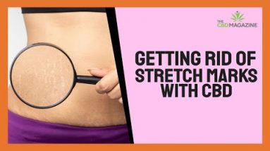 Does CBD oil eradicate stretch marks