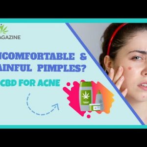 Combating pimples with CBD – Easy suggestions to make use of CBD oil for pimples?