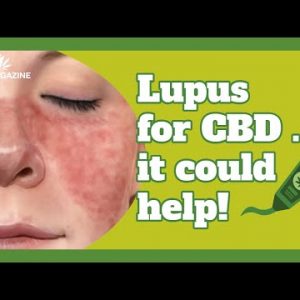 CBD cream for lupus – Can CBD oil assist with itchy pores and skin?